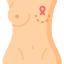 Breast cancer