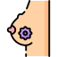 Breast cancer