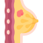 Breast cancer