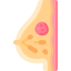 Breast cancer